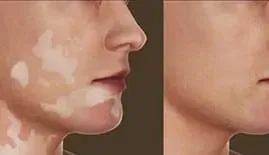 Arthrose