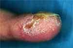 Finger Herpetic Whitlow