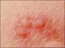 Cold Sores Cold Sores
